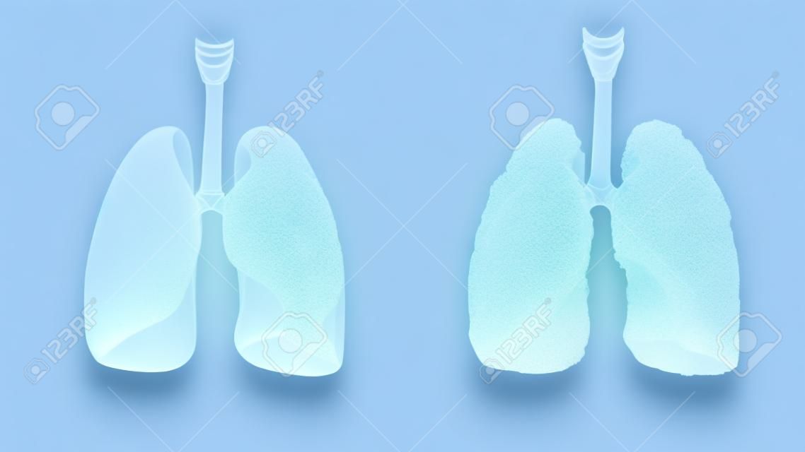 건강 한 폐 및 흰색 폐에 질병 폐 분리합니다. 부검 의료 개념입니다. 암 및 흡연 문제.