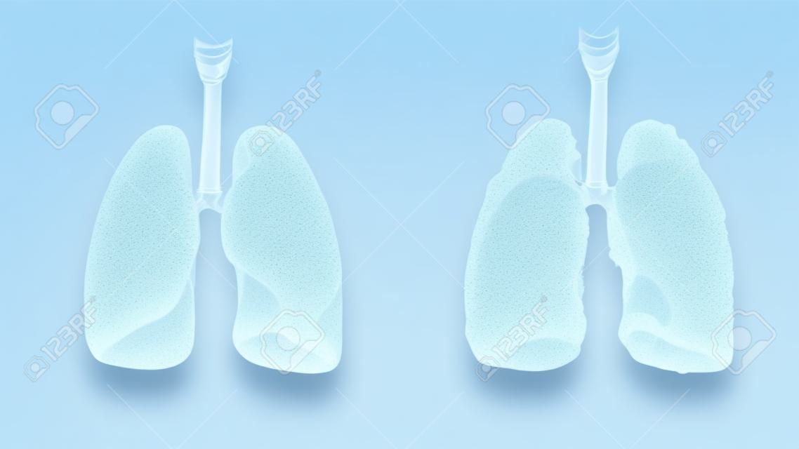 healthy lungs and disease lungs on white isolate. Autopsy medical concept. Cancer and smoking problem.