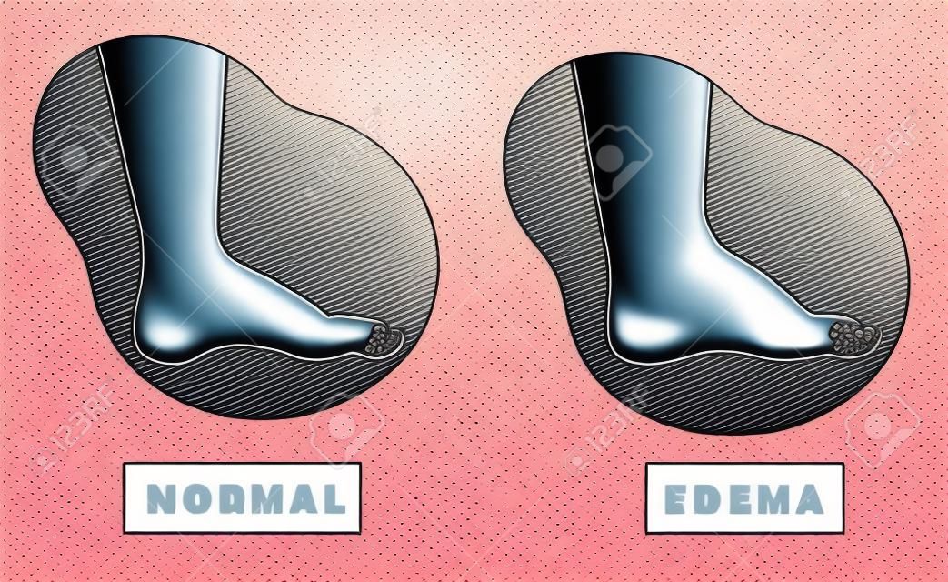 A swollen foot and ankle and a normal foot. Vector illustration