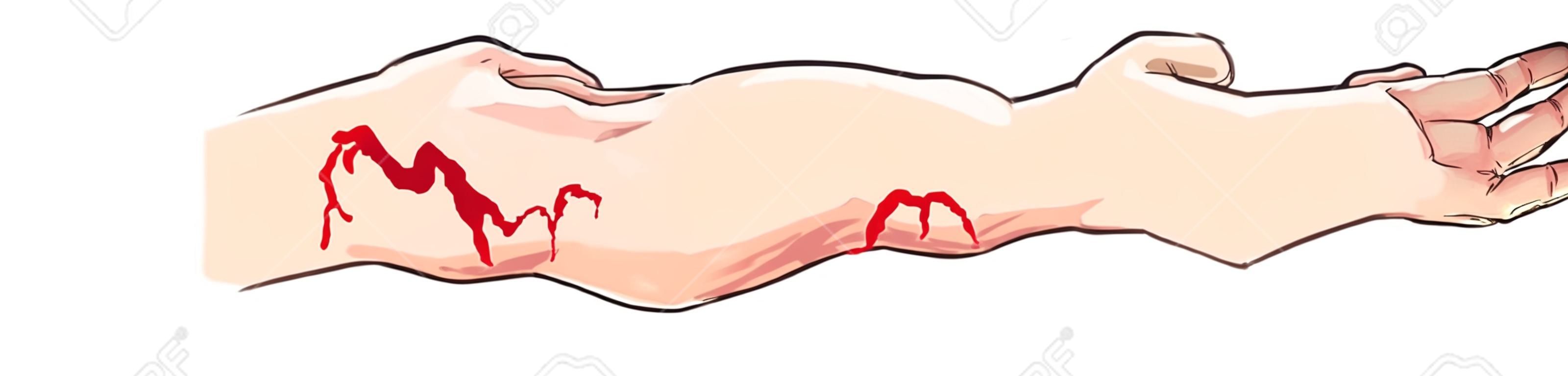 ilustración vectorial de un arterial y hemorragia venosa