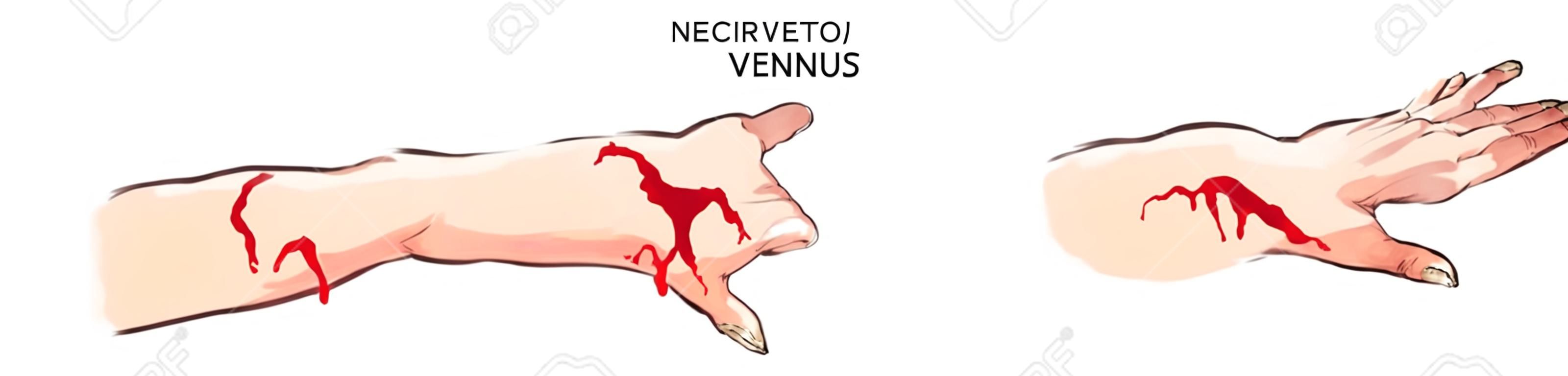 vector illustration of a  Arterial and venous bleeding
