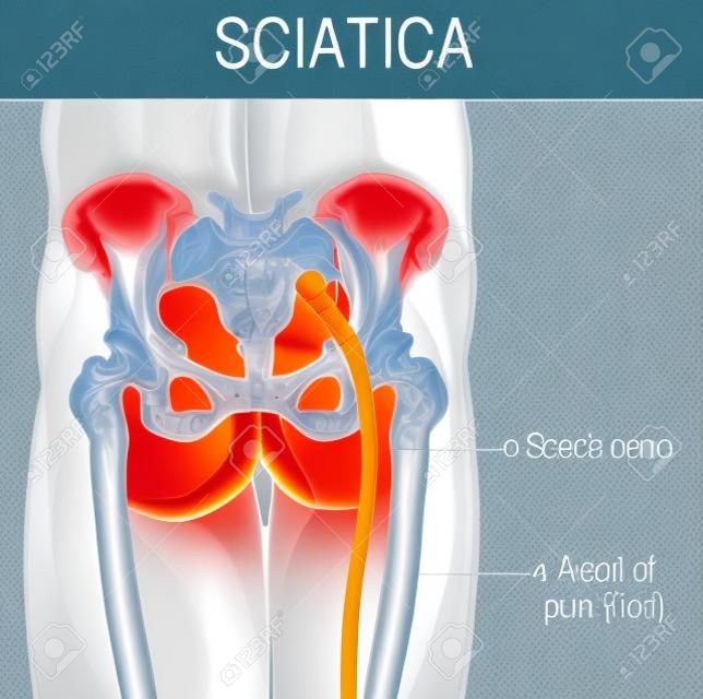 medical illustration of symptoms of sciatica