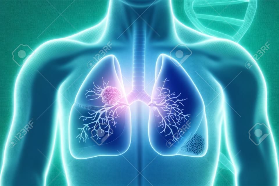 Cáncer de pulmón. enfermedad pulmonar. ilustración 3d