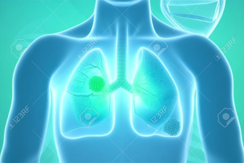 Lungenkrebs. Lungenerkrankung. 3D-Darstellung