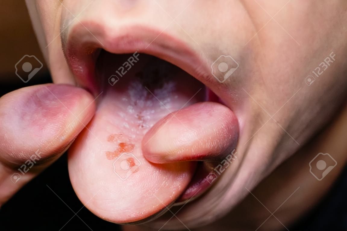 El macho muestra candidiasis de sobrecrecimiento en la lengua, boca abierta, sombras oscuras