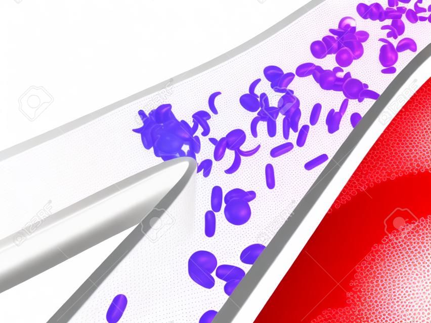 Cellules falciformes bloquant le flux sanguin - isolé sur blanc