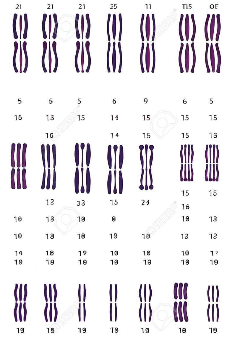 Human karyotype of Down syndrome. Autosomal abnormalities. Down syndrome have an extra copy of one of these chromosomes, chromosome 21. Trisomy 21. Genetic disorder