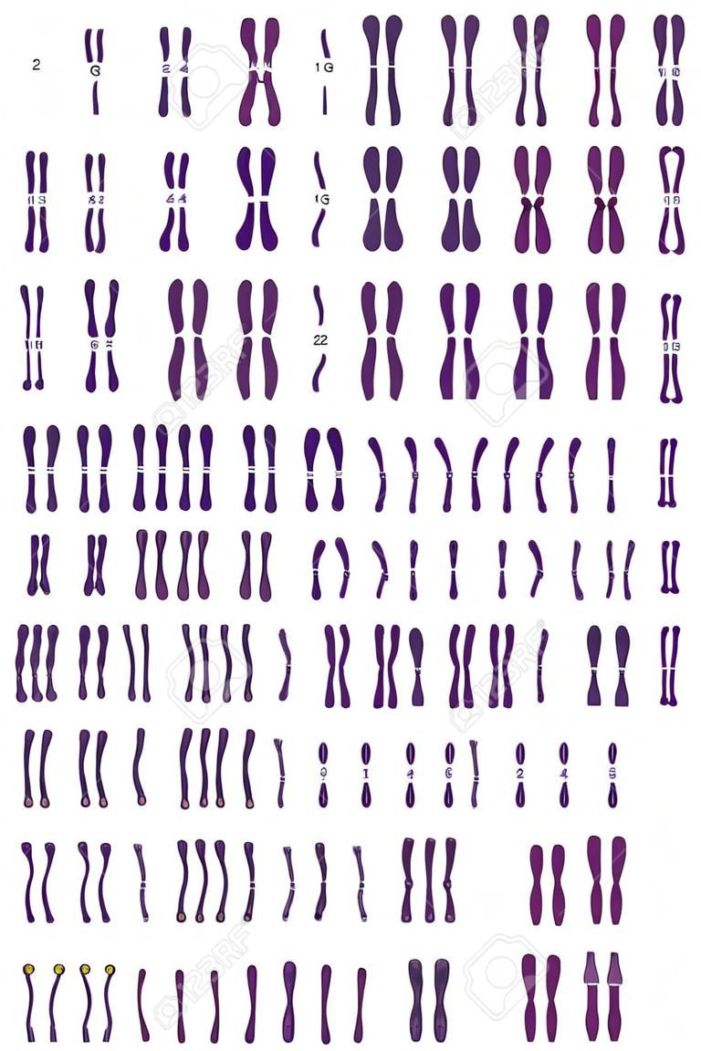 Human karyotype of Down syndrome. Autosomal abnormalities. Down syndrome have an extra copy of one of these chromosomes, chromosome 21. Trisomy 21. Genetic disorder