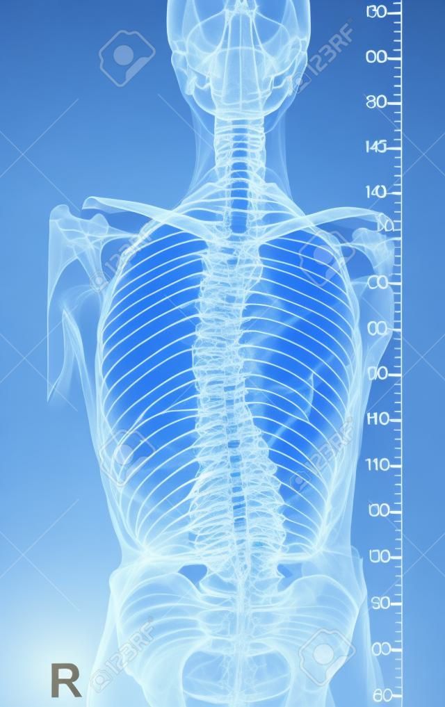 患有脊柱側凸的脊柱X線片，脊柱曲率