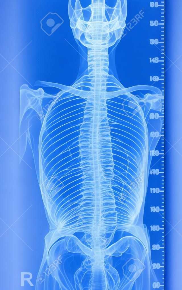 患有脊柱側凸的脊柱X線片，脊柱曲率