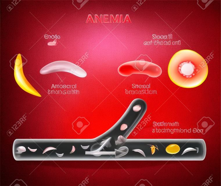 anemia. sickle cell and normal red blood cell