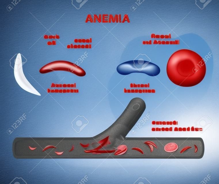 anemia. falciforme e normale globuli rossi