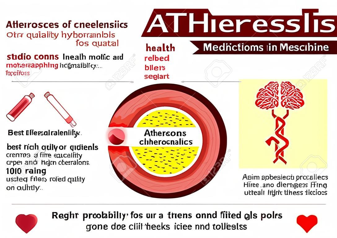 La aterosclerosis. problemas de salud. medicina en infografía médicos. elementos e iconos para el diseño. concepto.