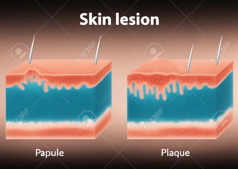 Papule and Plaque. Skin lesion. Papule is a solid elevation of skin and  accumulation of material in the dermis with no visible fluid. Plaque - confluence of papules