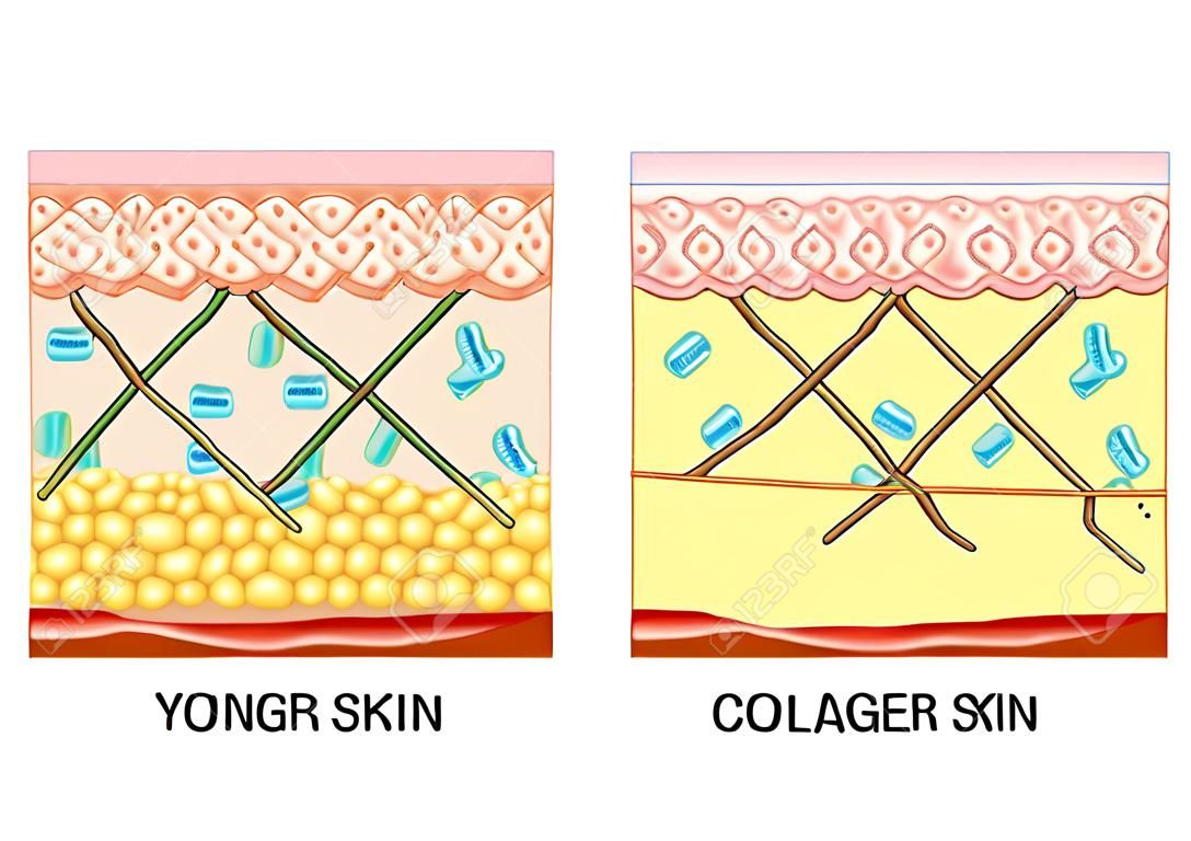 fiatalabb bőrt, és öregedő bőr. elasztin és kollagén. A diagram a fiatalabb bőrt, és öregedő bőr mutató csökkenése kollagén és elasztin törött idősebb bőrt.