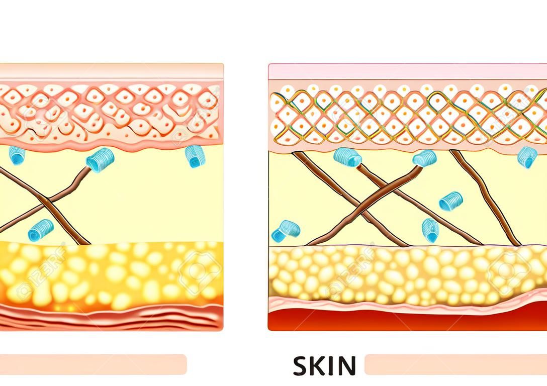una piel más joven y envejecimiento de la piel. elastina y colágeno. Un diagrama de la piel más joven y envejecimiento de la piel que muestra la disminución de colágeno y elastina en la piel rota más.