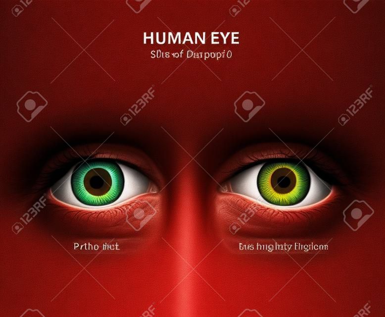 Menselijk oog. Grootte van de pupil in het donker en op een fel verlichte plaats. Pupil Verwijderd en Pupil vernauwd