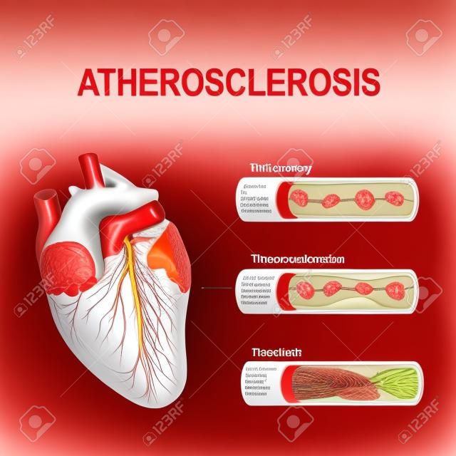 Ateroskleroz evreleri: Sağlıklı arter, plak oluşumu ve tromboz. Kalp krizinin anatomisi. Miyokard infarktüsü diyagramı. Koroner arterde aterosklerotik plak. Plak denilen yağ birikintileri insi oluşturduğunda arterler daralır