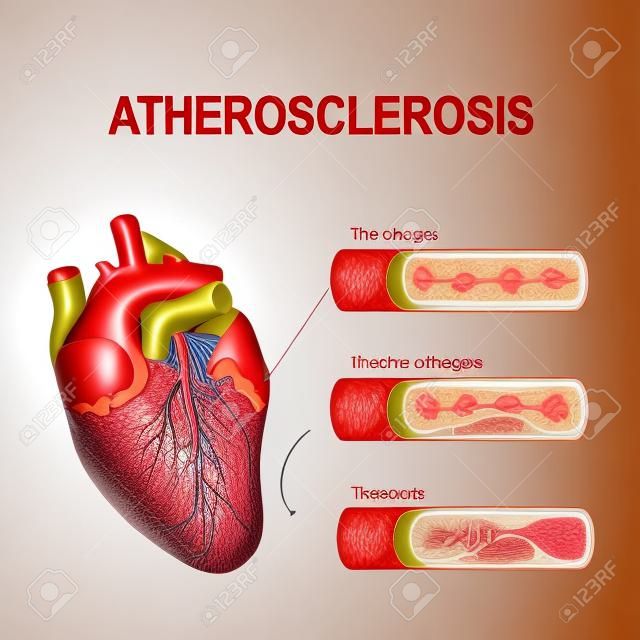 Ateroskleroz evreleri: Sağlıklı arter, plak oluşumu ve tromboz. Kalp krizinin anatomisi. Miyokard infarktüsü diyagramı. Koroner arterde aterosklerotik plak. Plak denilen yağ birikintileri insi oluşturduğunda arterler daralır