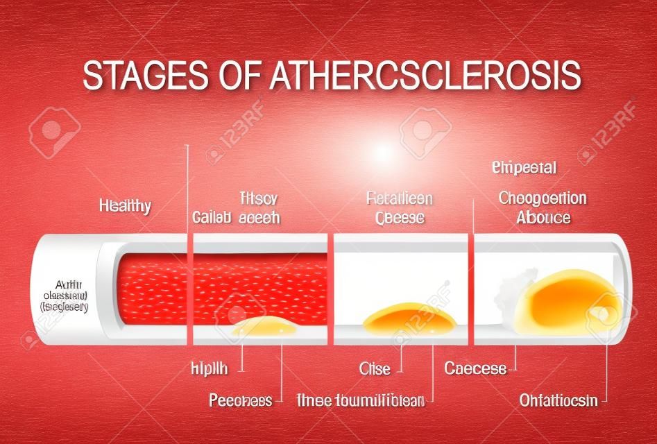 Estadios de aterosclerosis. Ilustración detallada. Arteria sana y arterias no saludables. Desarrollo de la placa de la raya grasa a Calcificación y trombosis. enfermedad cardiovascular. Anatomía humana