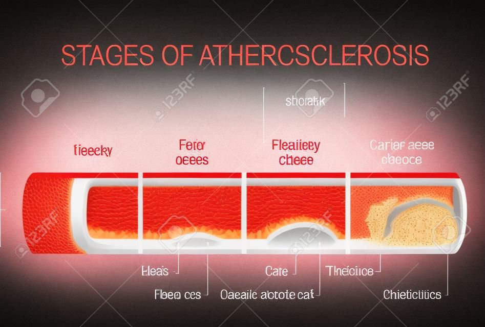 fasi di aterosclerosi. illustrazione dettagliata. dell'arteria sana e le arterie non sani. Lo sviluppo di placche da striscia grassi a calcificazione e trombosi. malattia cardiovascolare. Anatomia umana