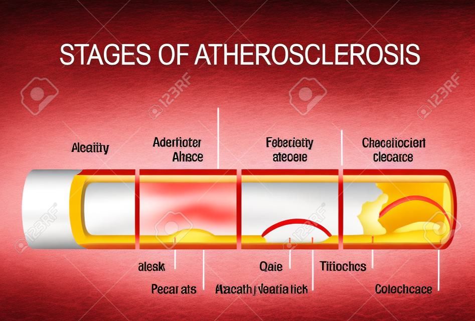 Estadios de aterosclerosis. Ilustración detallada. Arteria sana y arterias no saludables. Desarrollo de la placa de la raya grasa a Calcificación y trombosis. enfermedad cardiovascular. Anatomía humana