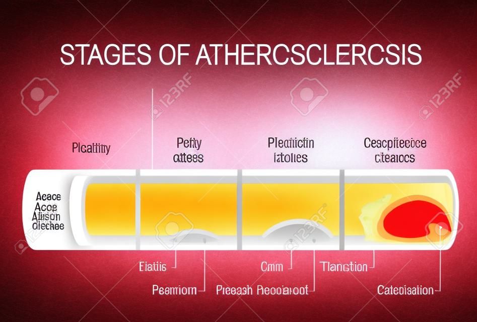stages of atherosclerosis. Detailed illustration. Healthy artery and unhealthy arteries. Developing of plaque from fatty streak to Calcification  and thrombosis. cardiovascular disease. Human anatomy