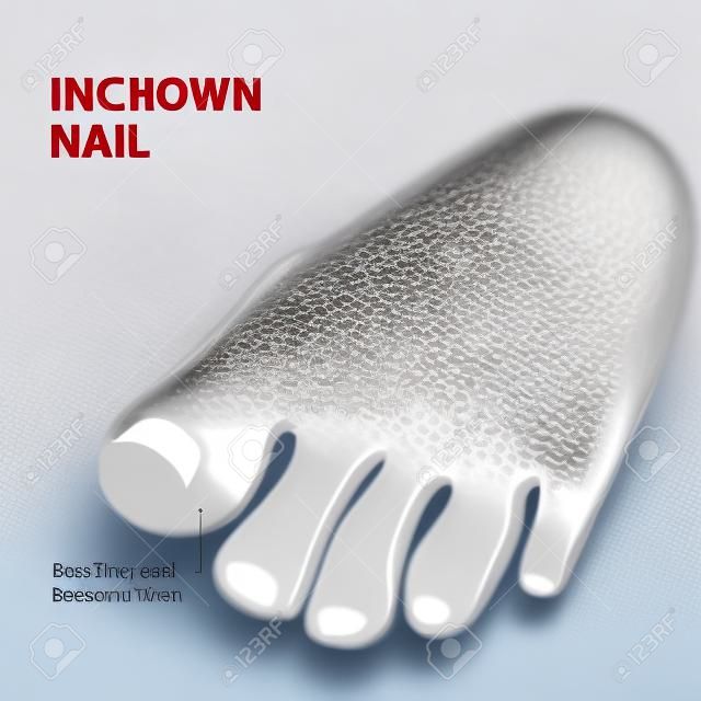 Ingrown nail. onychocryptosis. nail disease