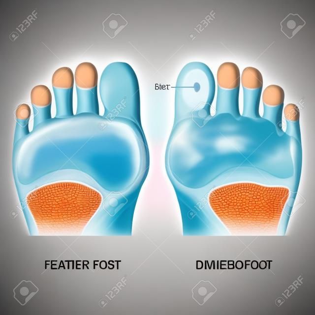 pied diabétique. Pathologie du bas du pied. Semelle mâle ou femelle. pieds nus.