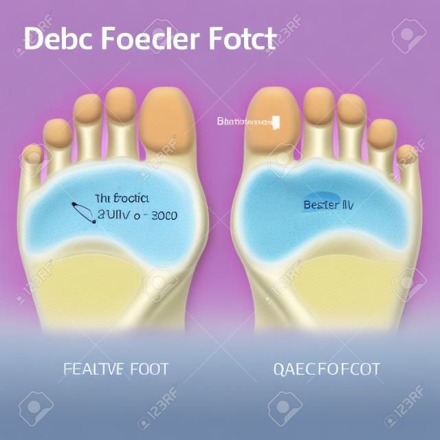 diabetikus láb. A lábfej alsó patológiája. Férfi vagy női talp. mezítláb.