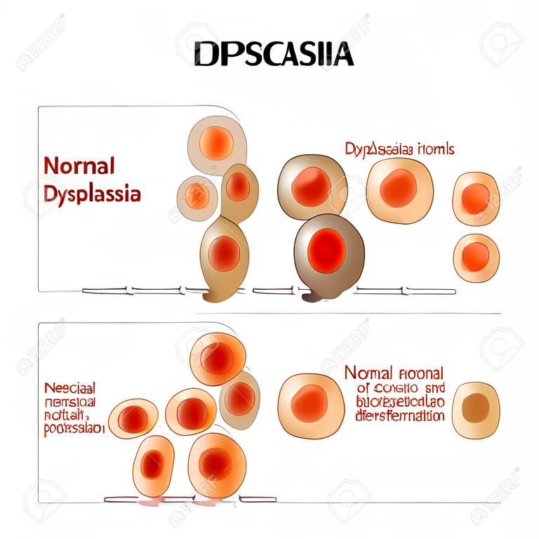 Normale cellen, Dysplasie (abnormaliteit van ontwikkeling, en differentiatie), en Neoplasie (abnormale, en overmatige groei van cellen). verschillend. Vector diagram voor educatief, medisch, biologisch en wetenschappelijk gebruik