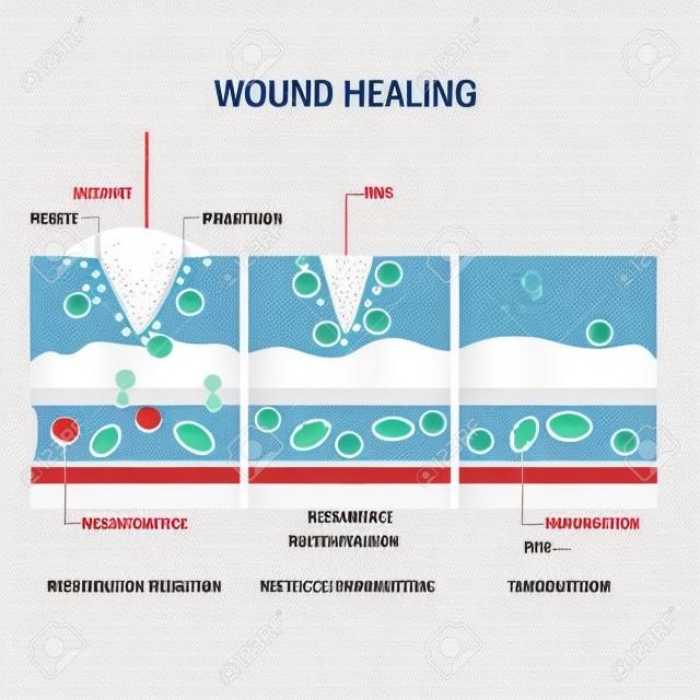 wound healing process. Hemostasis, Inflammatory, Proliferative, Maturation and remodeling. Tissue injury and inflammation. Immune system. vector diagram for medical, educational and scientific use.