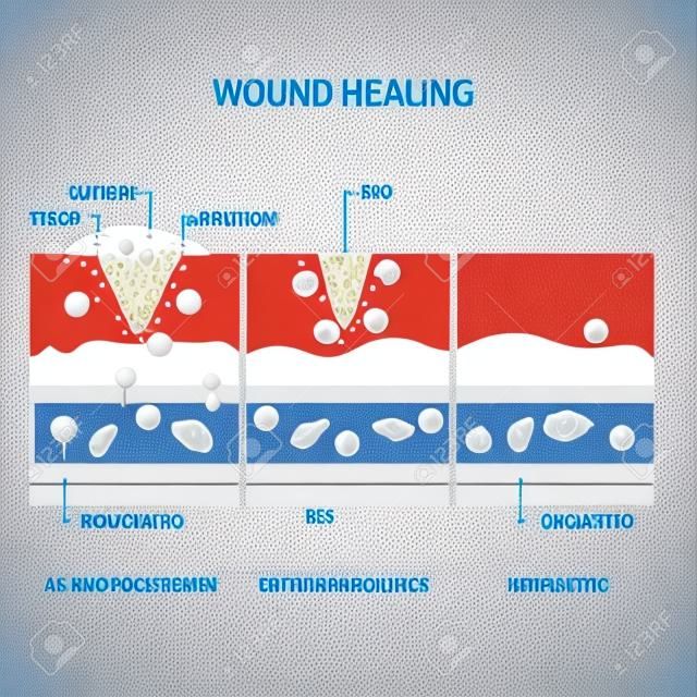 創傷治癒プロセス。止まり、炎症性、増殖、成熟および改造。組織の損傷と炎症。免疫系。医療、教育、科学的使用のためのベクトル図。