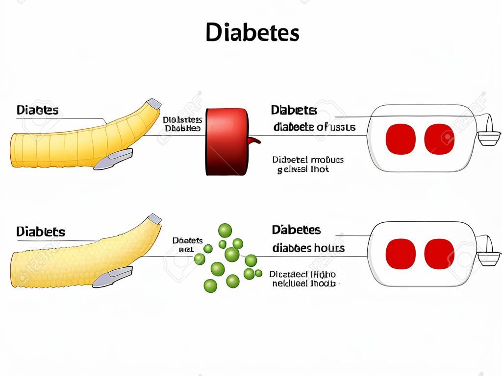 Arten von Diabetes mellitus.