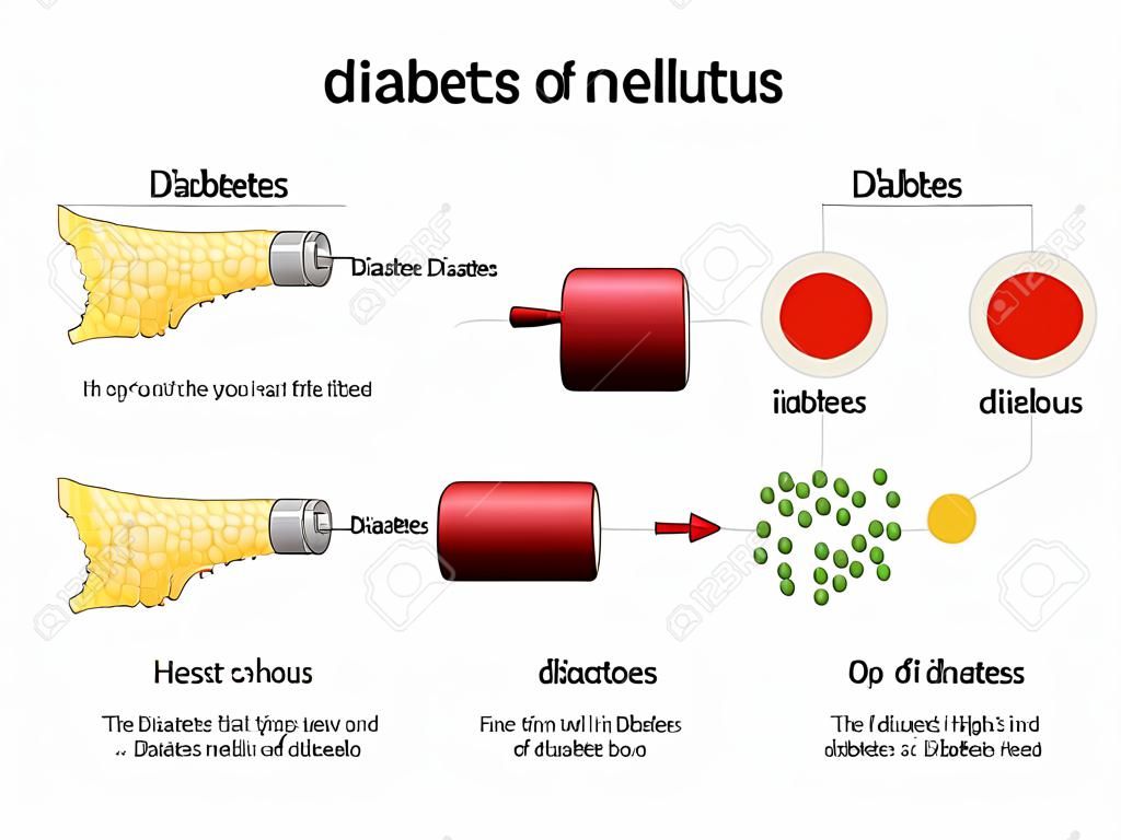 Tipos de diabetes mellitus.