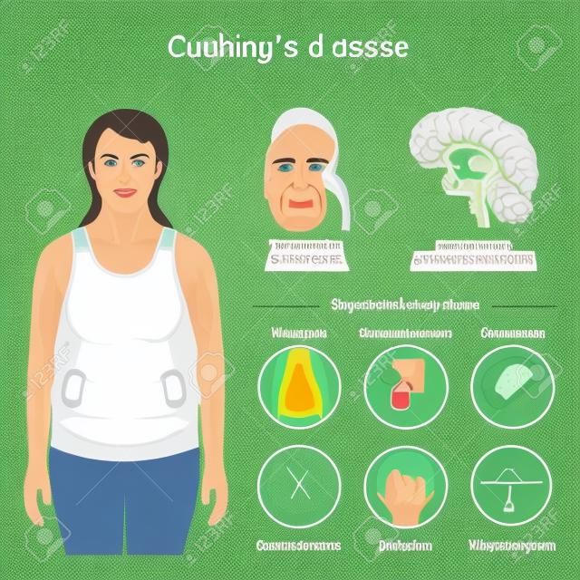 Cushing's disease. Signs and symptoms of Cushing syndrome. Vector illustration