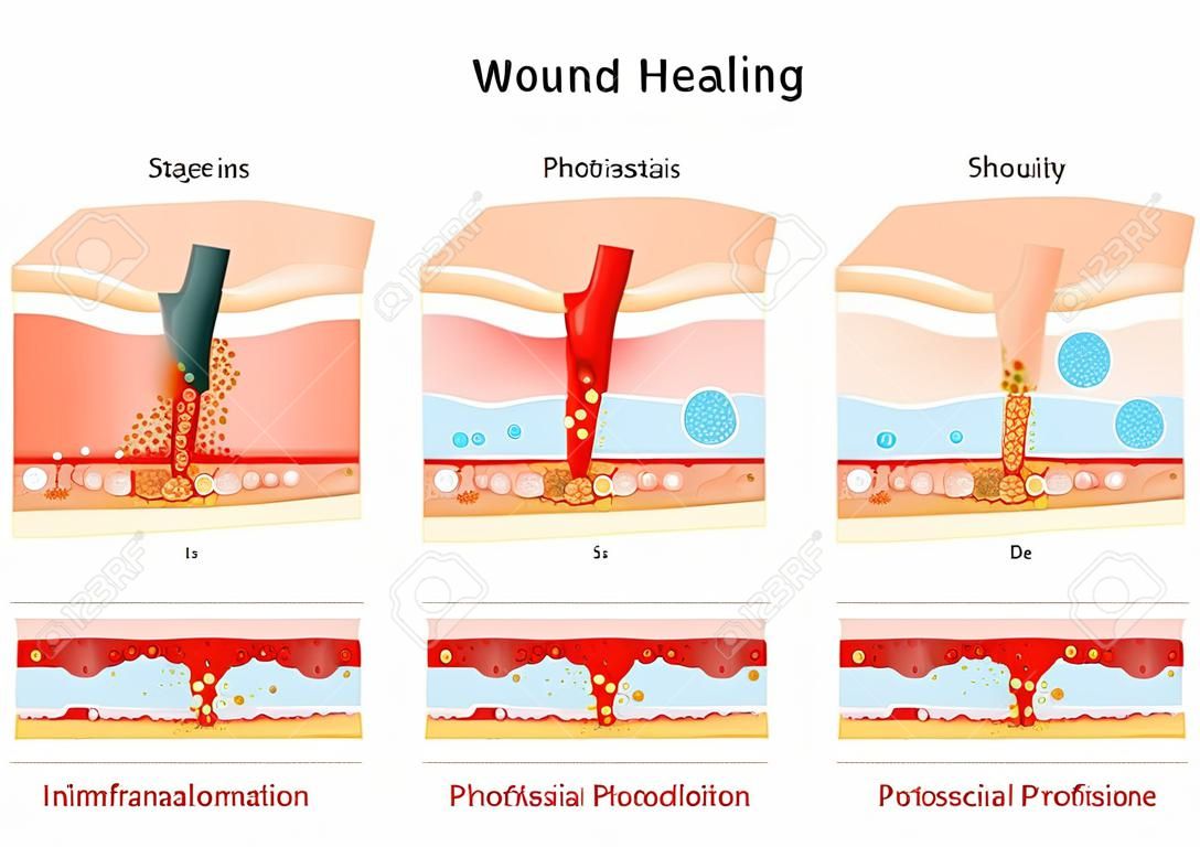 wound healing. Stages of the post-trauma repairing process. Hemostasis, Inflammatory, Proliferative, and remodeling phase. Cross section of a layers of the human skin