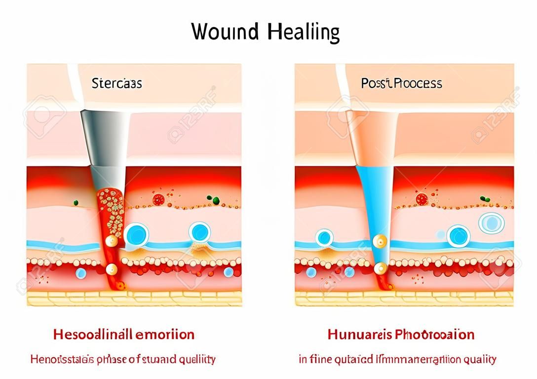 創傷治癒。外傷後の修復プロセスの段階。止血、炎症、増殖、およびリモデリングの段階。人間の皮膚の層の断面