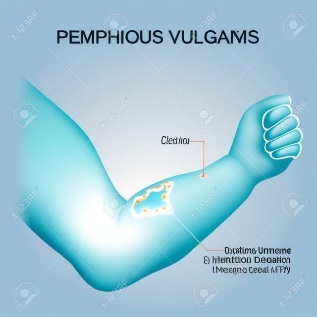 Pemphigus vulgaris. Arm mit Blasen und Läsionen, die an Größe und Verteilung im ganzen Körper zunehmen. Symptome einer Autoimmunerkrankung. Hautzustand. Vektor-Illustration