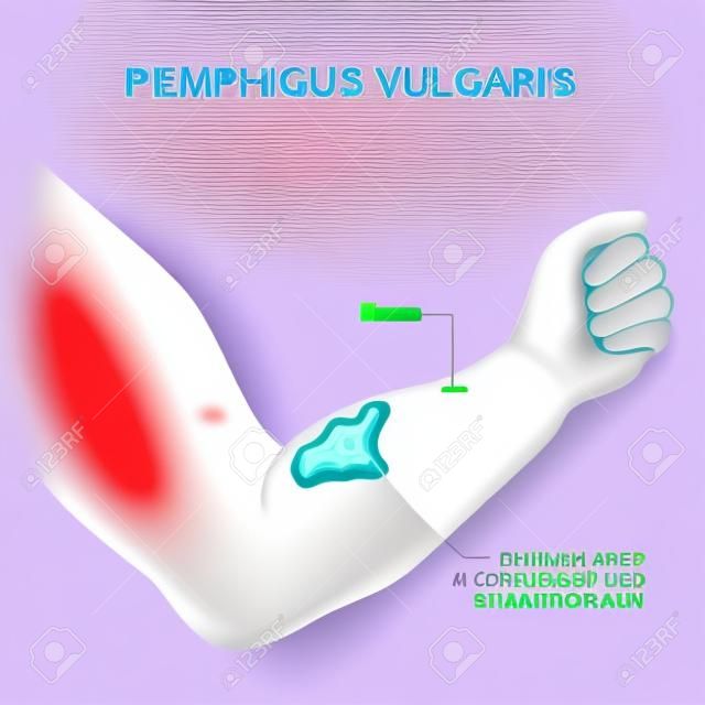 Pemphigus vulgaris. Arm with Blisters and Lesions that increase in size and distribution throughout the body. Symptoms of autoimmune disease. skin condition. vector illustration