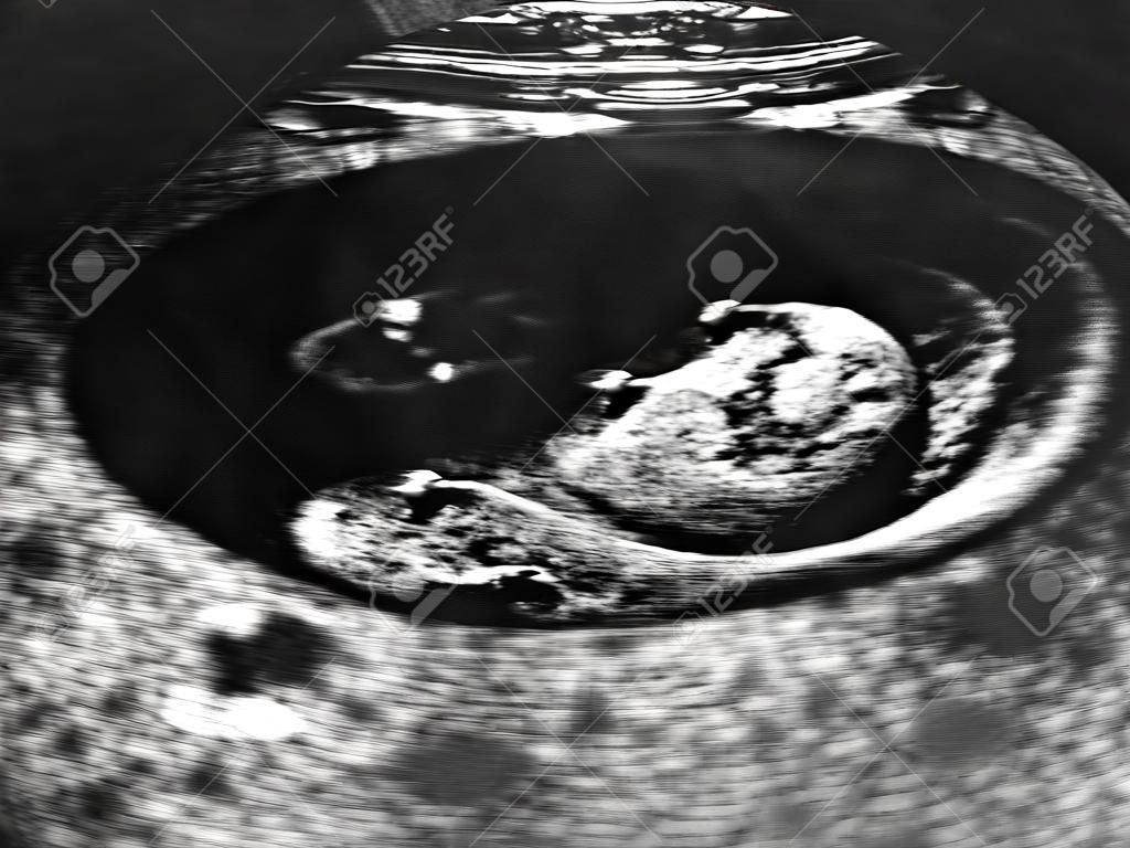 Ultraschall des Fötus 3 Monate in der Gebärmutter
