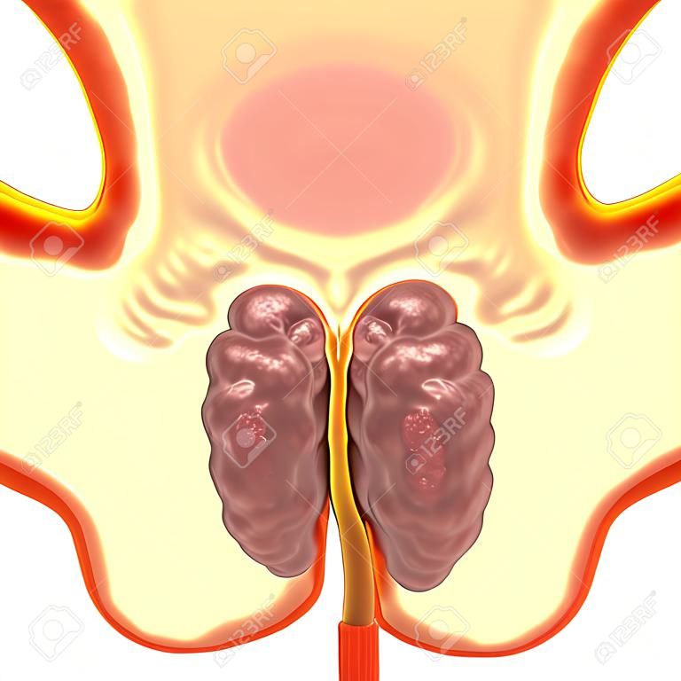 Benign prostatic hyperplasia, 3D illustration showing enlarged prostate gland