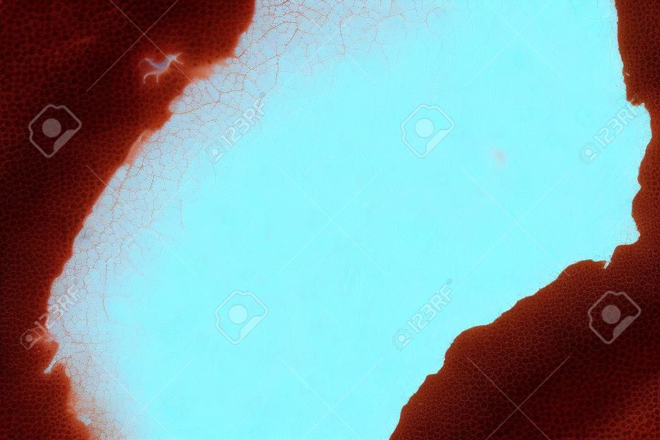 캘러스의 조직학, 압력, 반복된 마찰, 가벼운 현미경 사진의 결과로 만들어진 두꺼워진 피부. 현미경 사진