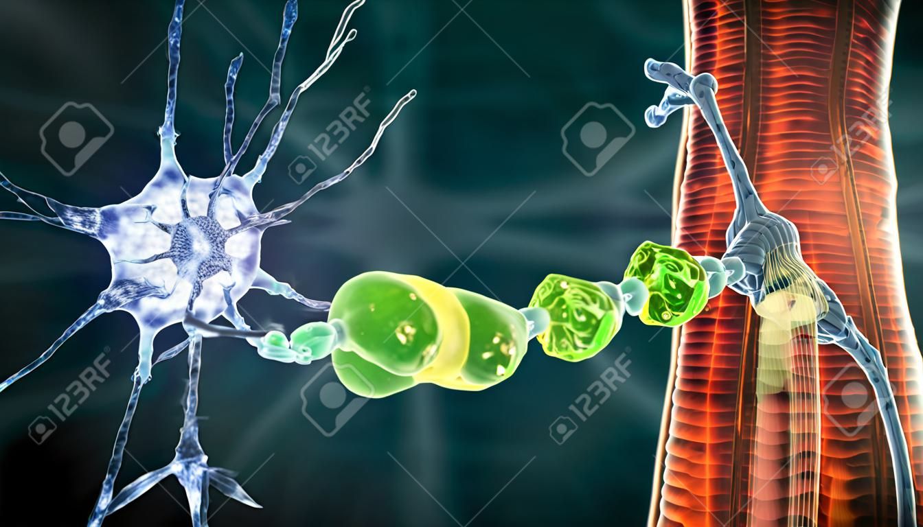 Desmielinização do neurônio, o dano da bainha de mielina do neurônio visto em doenças desmielinizantes, ilustração 3D. Esclerose múltipla e outras doenças mielinoclásticas e leucodistróficas desmielinizantes