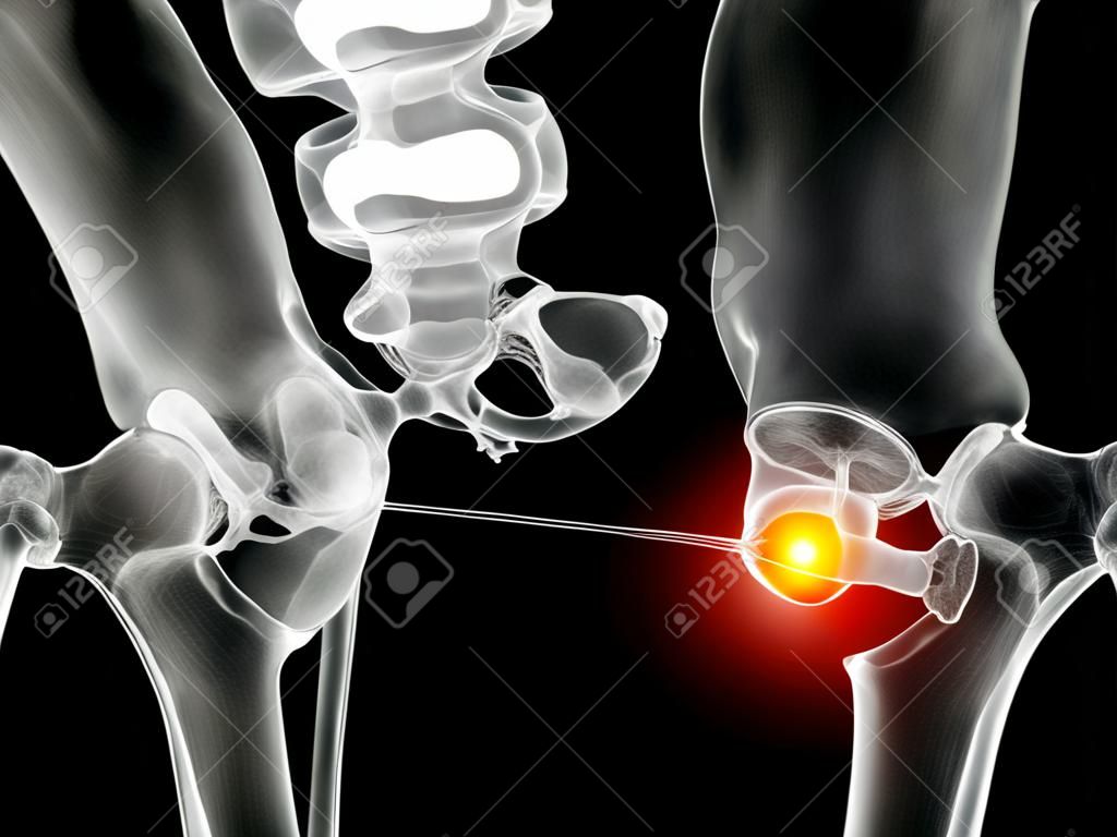 Funktionsstörung der Schambeinfuge 3D-Darstellung mit Darstellung der Beckenknochen und hervorgehoben in roter Schambeinfuge