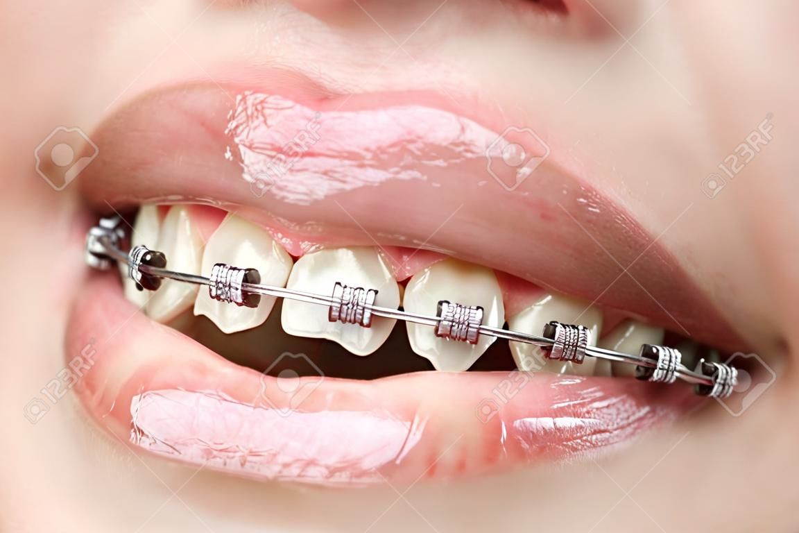 dientes con llaves