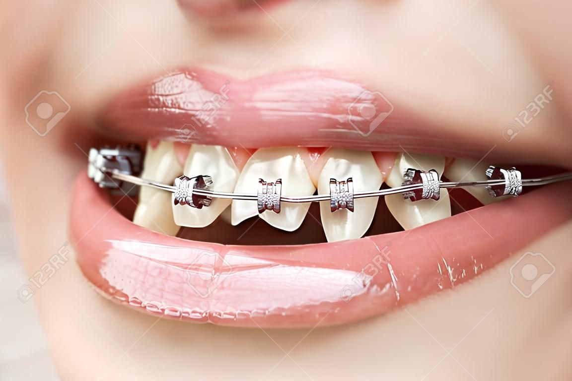 dientes con llaves