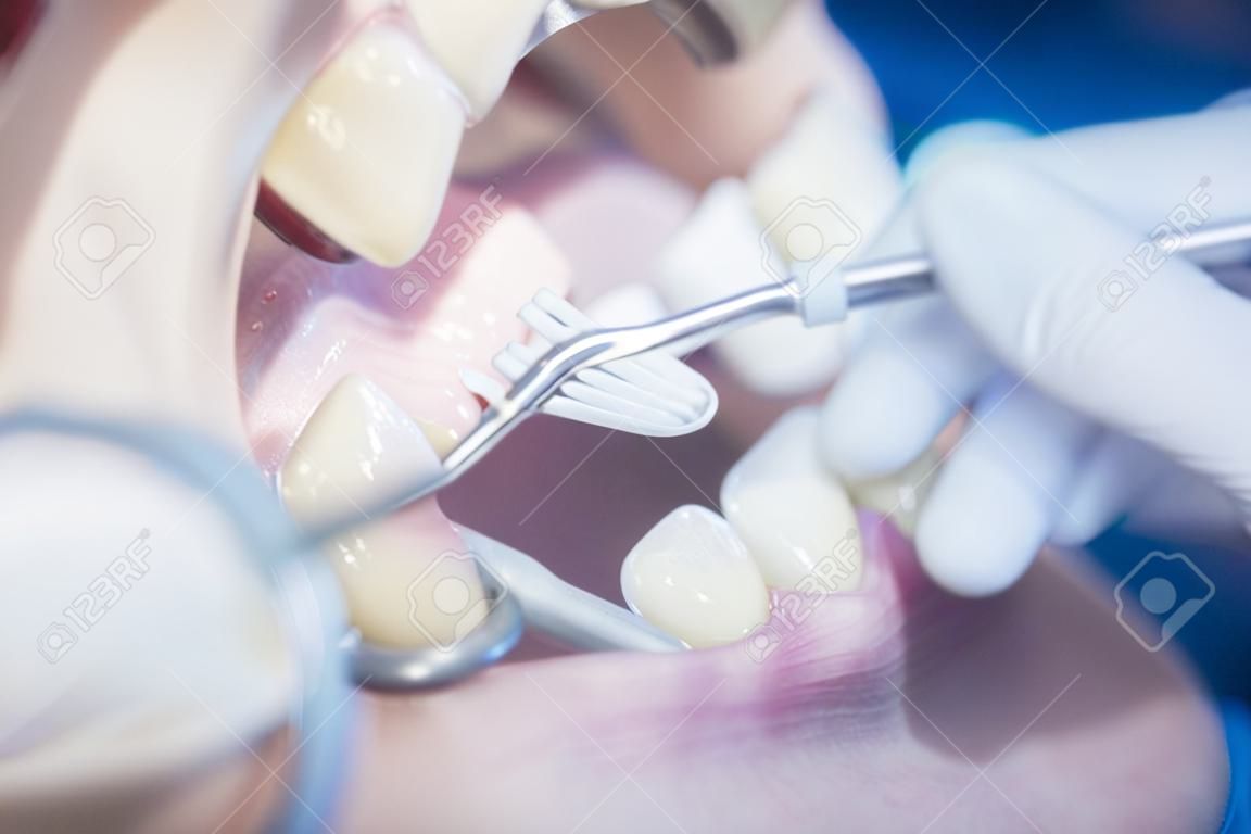 Stomatolog bada pacjenta w usta egzaminu dentystycznego czyszczenia z oprzyrządowaniem dentystycznym w klinice.