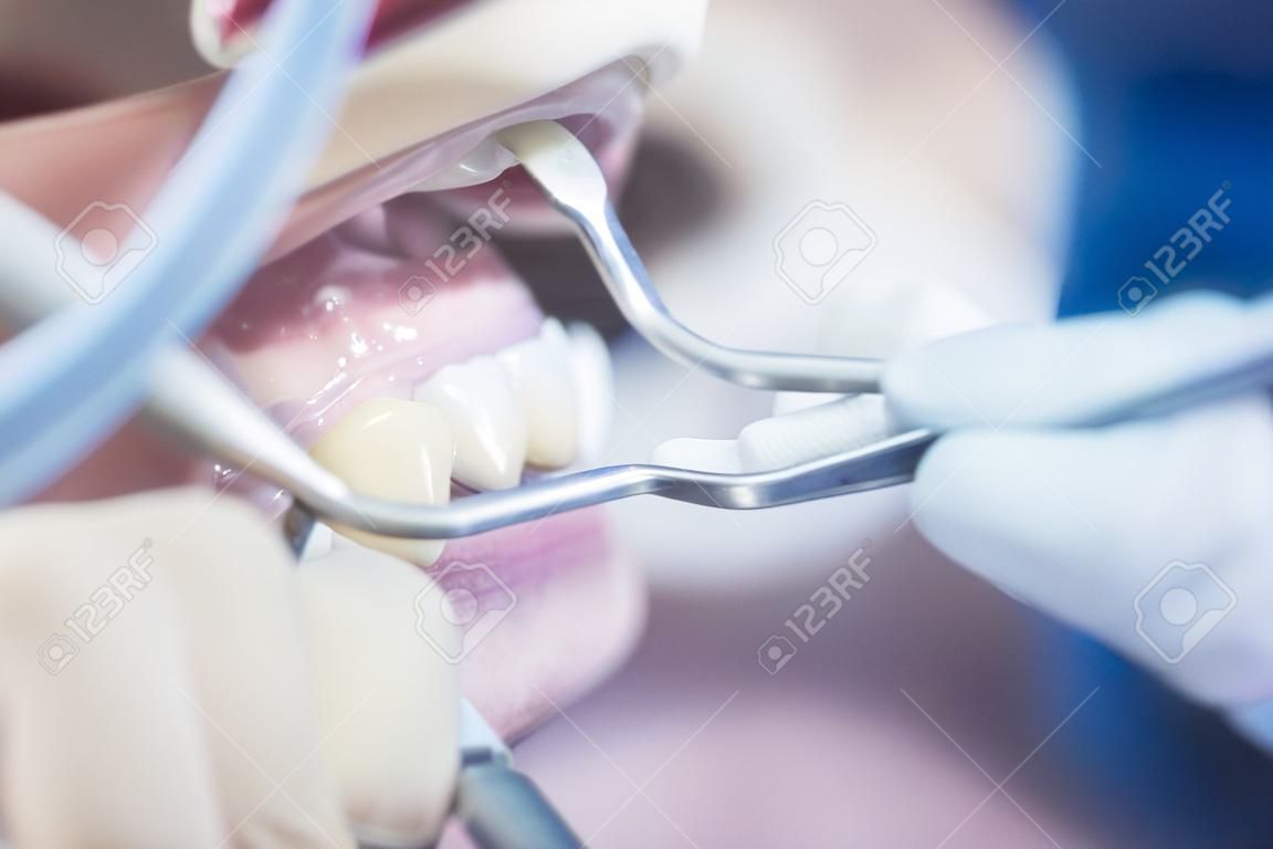 Dentist examining patient mouth in dental exam cleaning with dentist's instrumentation in clinic.