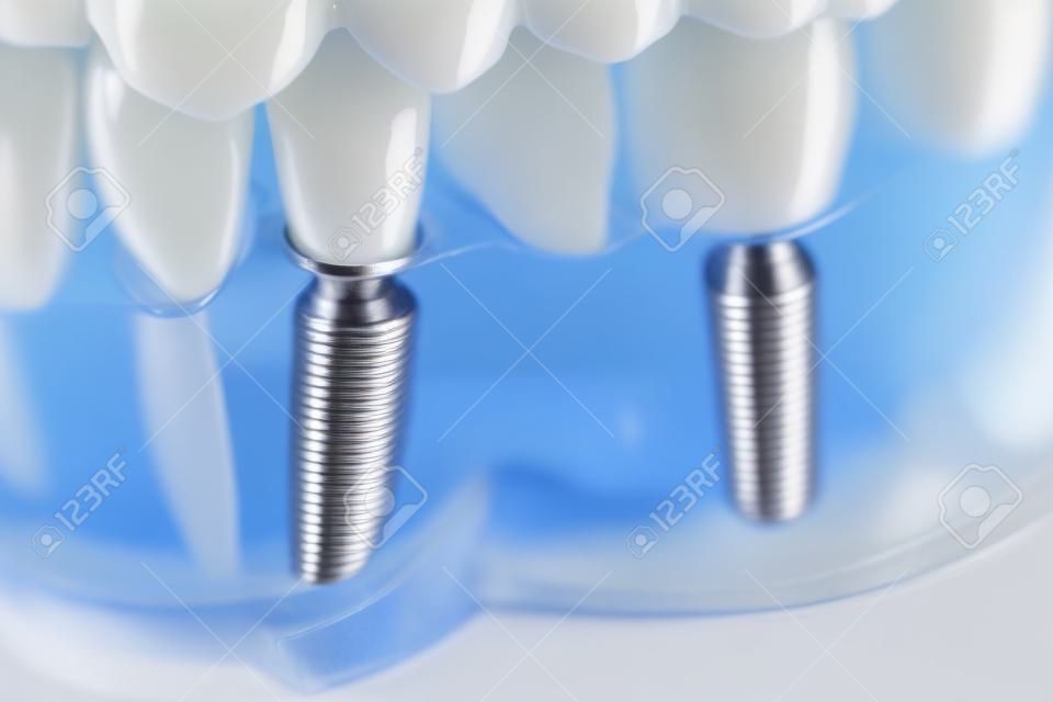 Tandheelkundige titanium esthetische orthodontische tandimplantaat in tandartsen mond tanden model closeup geïsoleerd.